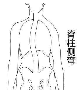 初次穿戴脊柱側(cè)彎矯形器的方法和要求