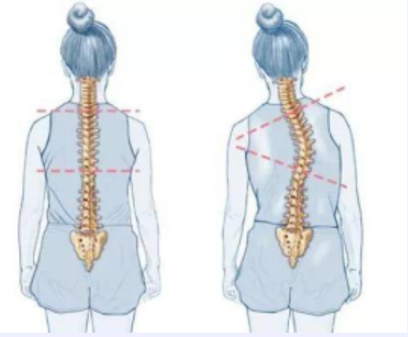 扁平足和脊柱側(cè)彎之間有關(guān)聯(lián)嗎？