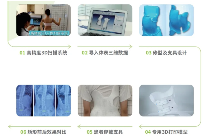 傳統(tǒng)脊柱側(cè)彎支具與3D打印矯形支具的區(qū)別  